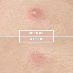 COSRX Acne Pimple Master -Maybelline-winkel 550x462 1