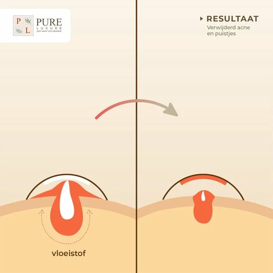 Pure Luxure Pimple Patch 144 ST - Acne Patch - Acne - Acne Pleister - Pimple Patches - Puisten Verwijderaar 8 Pure Luxure Pimple Patch 144 ST - Acne Patch - Acne - Acne Pleister - Pimple Patches - Puisten Verwijderaar - Afbeelding 8